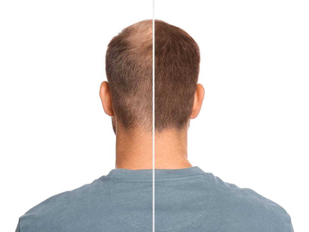 HMB Hair Loss Effects: Does It Increase Or Inhibit Hair Growth