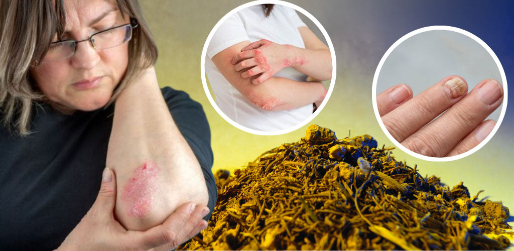 Is Goldenseal Antifungal? How to Use It for Candida Treatment?