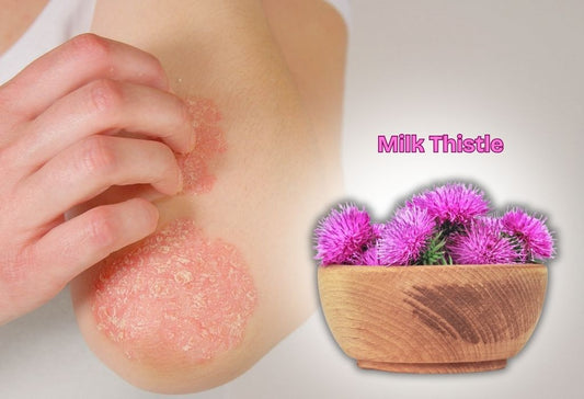 does milk thistle help psoriasis
